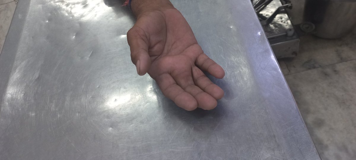 DrVijaySushil's tweet photo. #orthocase
A 55 years old male presenting with gradually progressive swelling of the hand since last 4 years. What can be the diagnosis?
#orthotwitter https://t.co/M11xoNPoEi