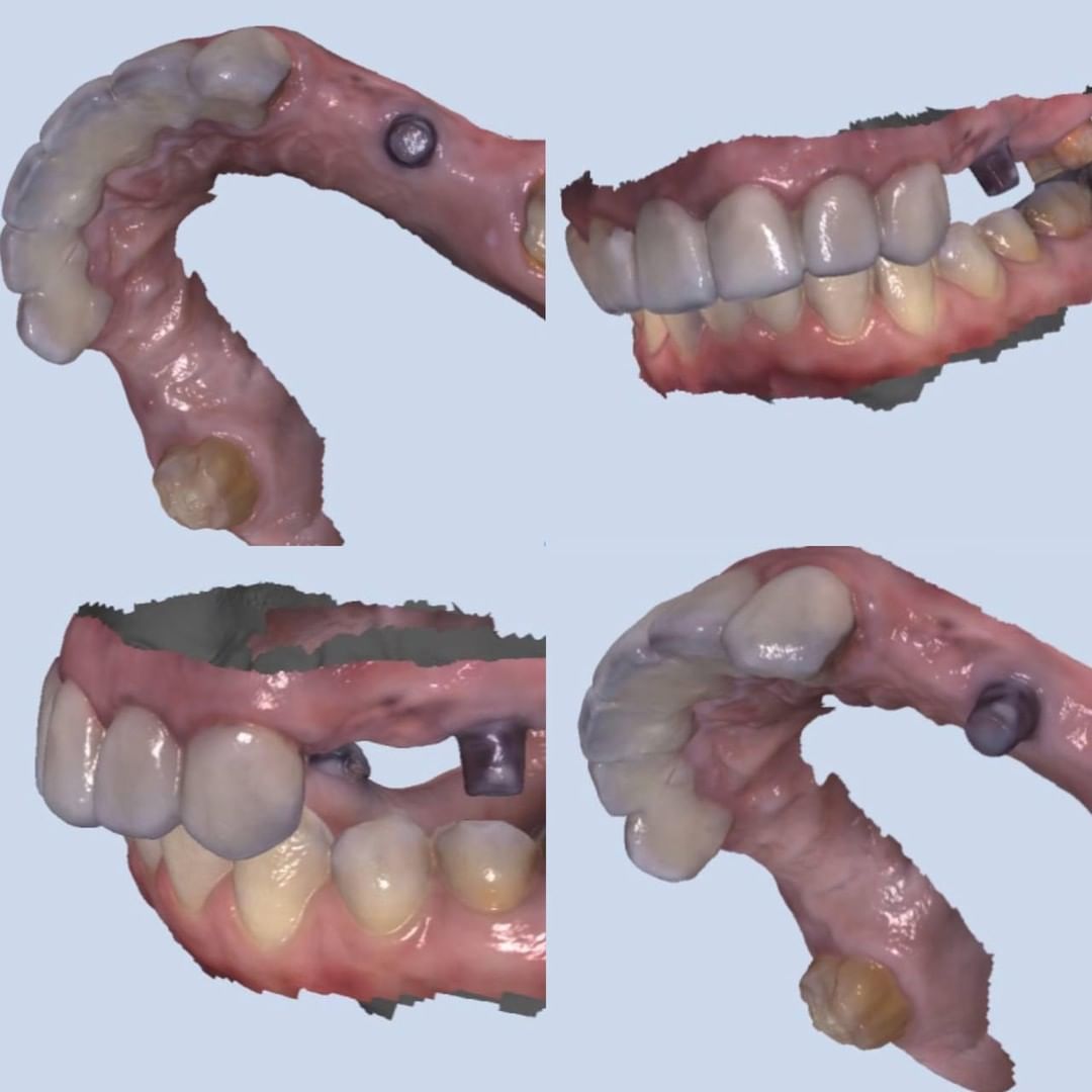 intraoralscan's tweet image. Launca helps dentists worldwide to improve their efficiency through accurate scanning. Implant case data shared by Launca end users using the Launca DL-206

#launca #shining3d #medit #intraoralscanner #dentis #zahntechnik #zahntechniker #zahntechnikermeister