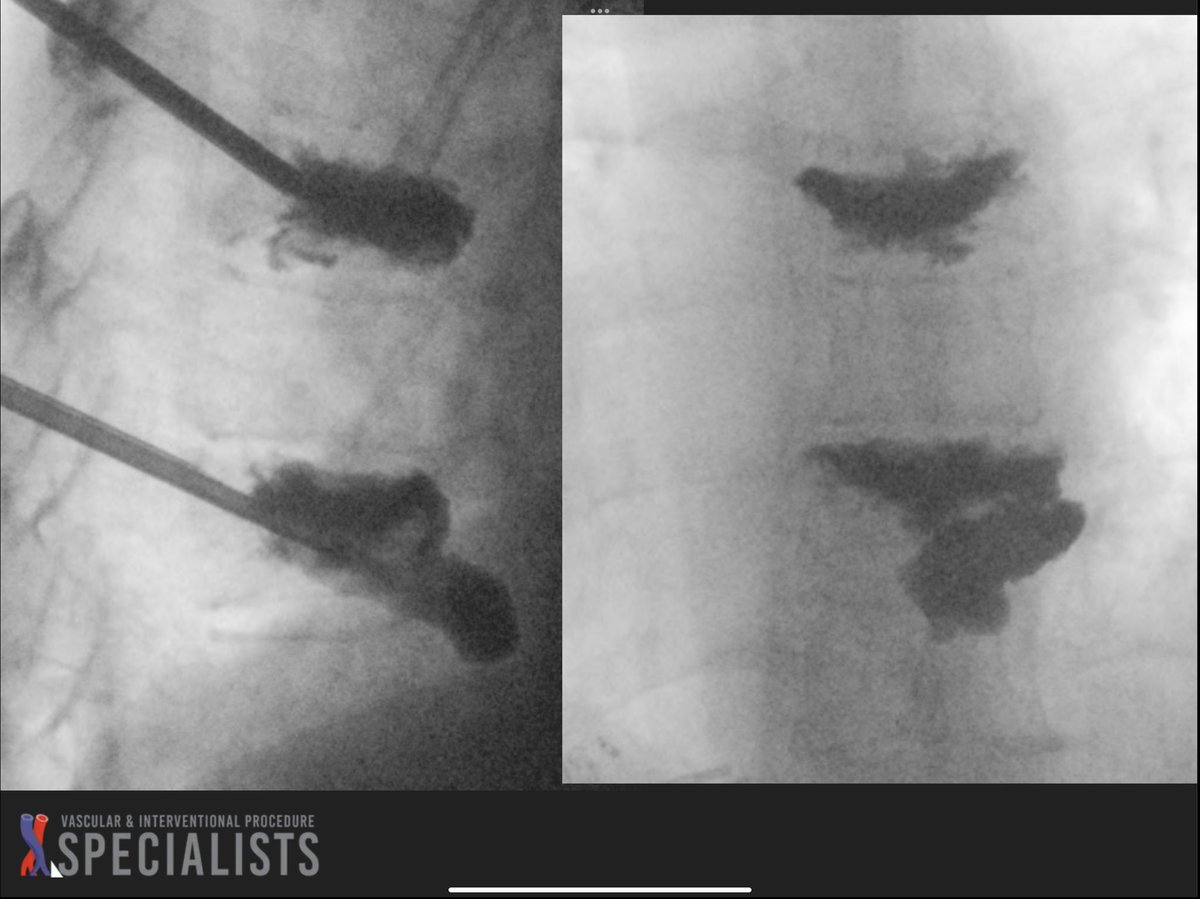 darthglader's tweet photo. Injected cement into these two vertebral bodies. Unfortunately restoring the height of the T9 vertebral body disrupted the right side of T9 - quite a bit of cement spilled out, marring an otherwise pretty picture. But, still good height restoration. And, T7 is #FillGoals. https://t.co/cgThxSm7gx