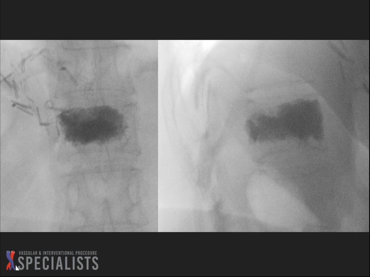 darthglader's tweet photo. Finally, single-needle approach at T12 got midline for single-balloon #kyphoplasty, with excellent fill. 
#WallToWallFloorToCeiling 
#FillGoals 

Left with no upper back pain. #ThankYouEpiduralBlock 

#ComingBackForTheThreeLumbarVertebrae
#NextTimeEggshellTechnique https://t.co/g6t8JAVcIc