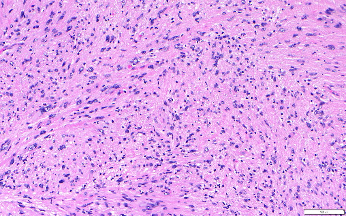 bitar_mireille's tweet photo. Spinal tumor diagnosis?
#neurosurgery #spinesurgery #PathTwitter #neurotwitter #grosspath #bstpath #surgpath #pathboard https://t.co/LT1vt1MiNl