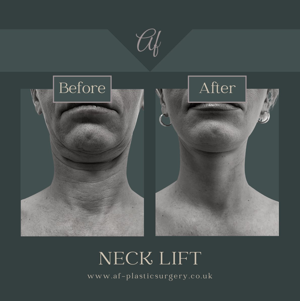 afplasticsurgry's tweet photo. We love the results of this neck lift surgery. 

#manchestercosmeticsurgery #cosmeticsurgeon #celebritycosmeticsurgeon #afplasticsurgery #surgery #surgeryuk #plasticsurgeryclinic #plasticsurgeon #plasticsurgeons https://t.co/KhmZrhME9o