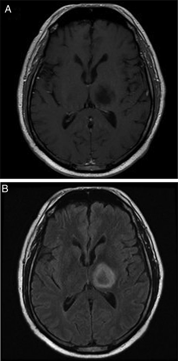 guerreroespejo's tweet photo. A 48-YO👨, sarcoidosis, progressive right-sided hemiparesis
MRI: L thalamus &amp; temporal horn abnormalities (1)
Brain🔬(2) foamy macrophages, enlarged naked nuclei with ground glass inclusions, &amp; giant astrocytes with bizarre or multiple nuclei
1/
https://t.co/7kKZXMrMw5
#pathology https://t.co/0W8F29x4x0