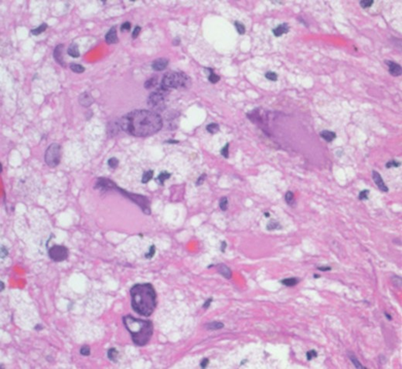 guerreroespejo's tweet photo. A 48-YO👨, sarcoidosis, progressive right-sided hemiparesis
MRI: L thalamus &amp; temporal horn abnormalities (1)
Brain🔬(2) foamy macrophages, enlarged naked nuclei with ground glass inclusions, &amp; giant astrocytes with bizarre or multiple nuclei
1/
https://t.co/7kKZXMrMw5
#pathology https://t.co/0W8F29x4x0