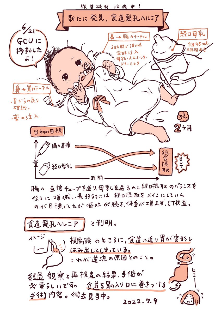娘の腹壁破裂治療進捗メモ③ 