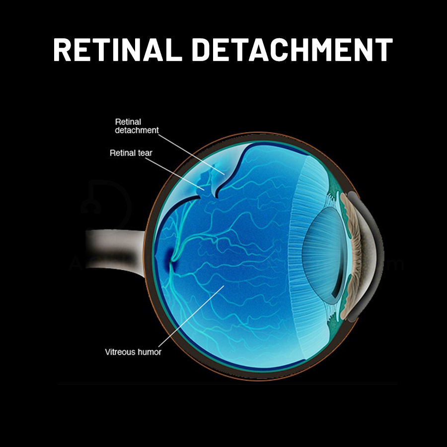 Docsteth1's tweet photo. The retina can tear in a very small area and lead to a large retinal detachment.
To know more about Retinal Detachment click on the link
🔗https://t.co/tNZPjww5xn
#RetinalDetachment #Retina #Blindness #Trauma #Ophthamology #Docsteth #DocstethPost #MedTwitter https://t.co/xDc5vehCj8