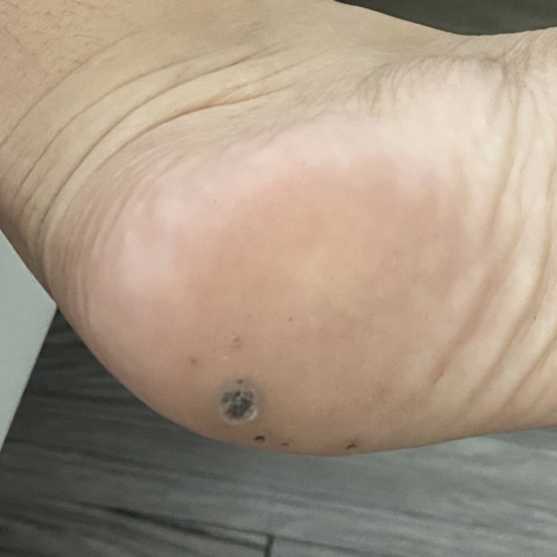 ahmadsharing88's tweet photo. Sorry if my photo is disturbing, but I really need to share this ‼️

I dah lama gilaa ada ketuat kt kaki tau, but this thing helps to remove the corn painlessly! Nak guna pun mcm pakai plaster je, senang hidup 🥳 https://t.co/zq1tO9iibg