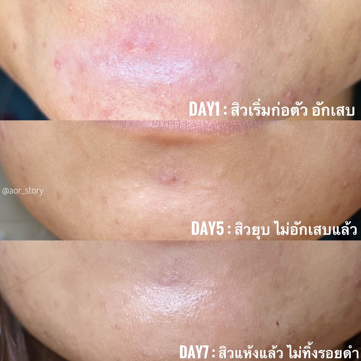 เจลแต้มสิววาซาบิ ลองกับสิวอักเสบตรงคาง นึกว่าจะปะทุ แต่นางยุบจ้า ยุบแบบแห้งไปเลย พวกสิวเล็กๆรอบๆก็เหมือนจะหายไปด้วย อ้างอิงตามรูปเลยจ้า เนื้อจะเหลวๆเหมือนเซรั่มมากกว่าเนื้อเจลนะ ส่วนตัวไม่ได้แพ้ #ใช้ดีบอกต่อ #เจลวาซา