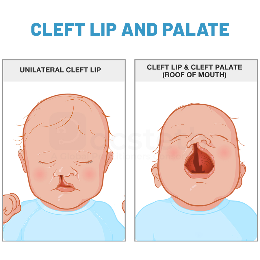 Docsteth1's tweet photo. Cleft lip surgery must be done before 12 months of age
To know more about Cleft Lip And Palate click on the link
🔗https://t.co/JL9PFfqCeF
#CleftLip #Palate #PlasticSurgery #Genetics #Orthodontics #Dentistery #Docsteth #DocstethPost #MedTwitter https://t.co/x75kgzDKkK