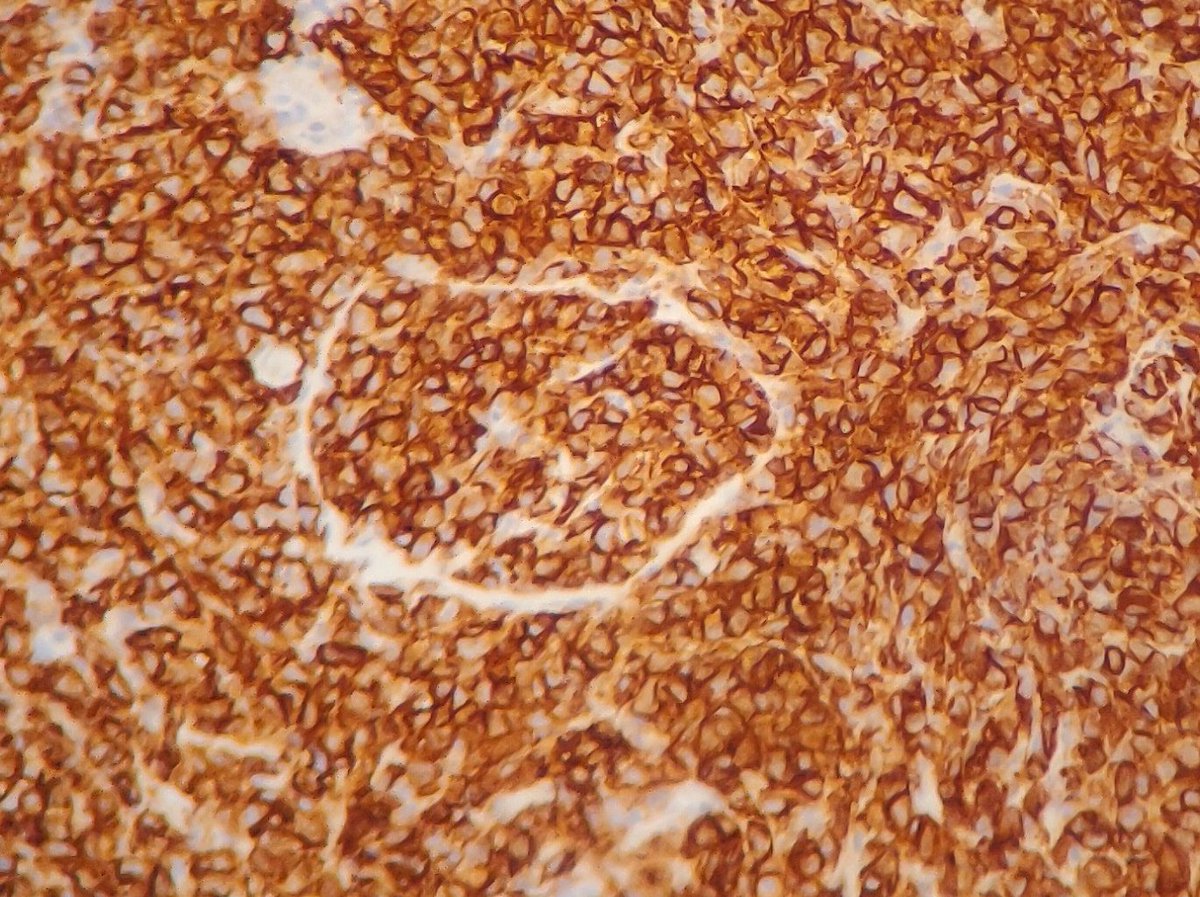 You can barely tell a glomerulus in this impressive CD20+ monomorphic infiltrate.
PTLD
#renal #renalpath #kidneypath #Transplant