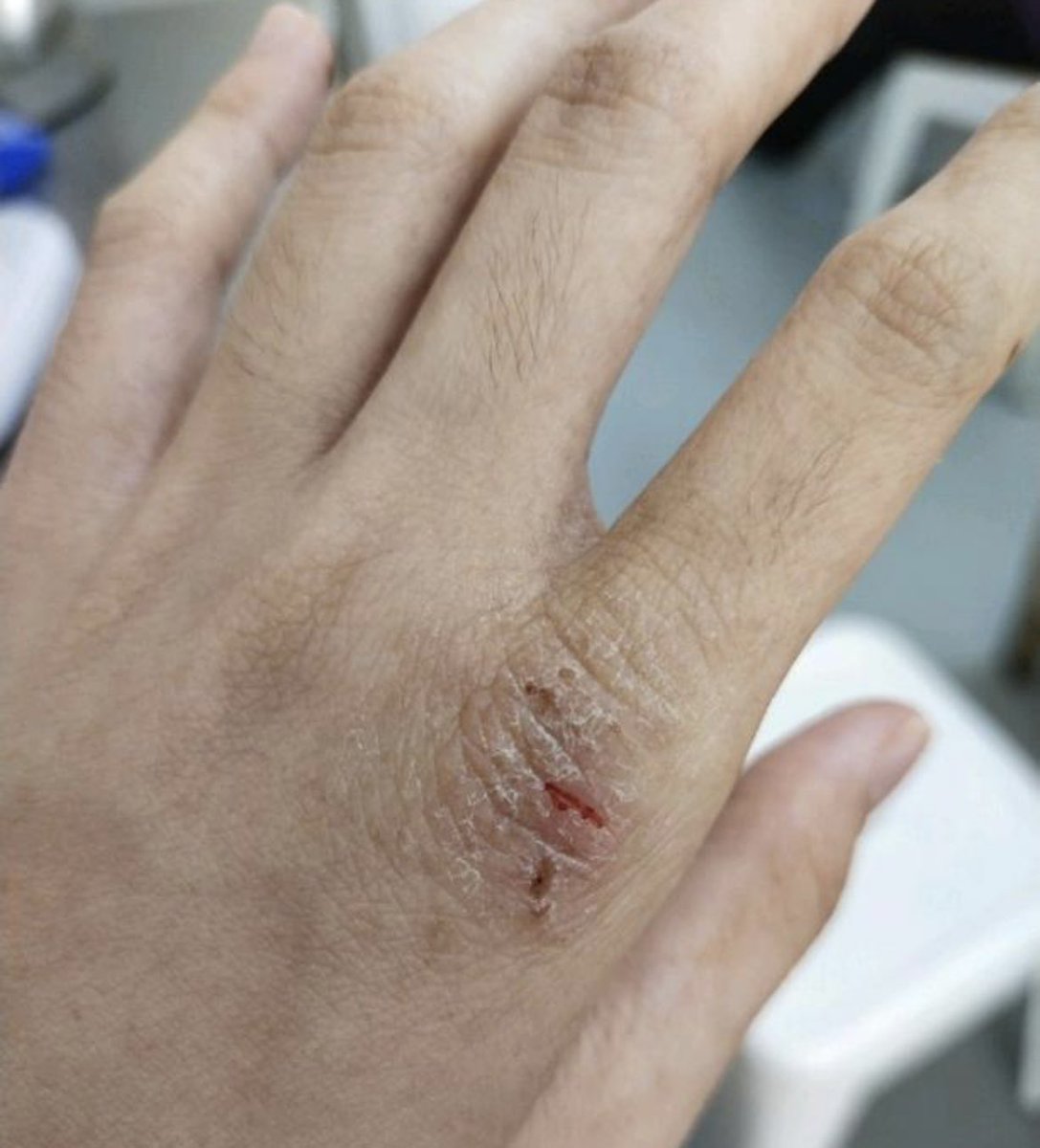 officialfans95's tweet photo. Terbaik sangat krim ni.. 3 tahun cari krim yg sesuai, beribu dah habis.. Dh lah menderita kene eczema ni.. Tpi yg ni baru rm3 je 😭 Syukur sgt pakai 1 tube ni dah elok tnpa gatal &amp; berdarah lgi.. Siap2 simpan stok.. 
.
Beli sini: https://t.co/nI3laE1L29 https://t.co/LtEYACWBg7