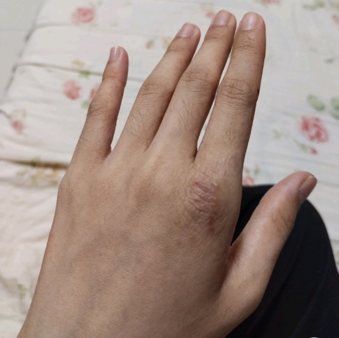 officialfans95's tweet photo. Terbaik sangat krim ni.. 3 tahun cari krim yg sesuai, beribu dah habis.. Dh lah menderita kene eczema ni.. Tpi yg ni baru rm3 je 😭 Syukur sgt pakai 1 tube ni dah elok tnpa gatal &amp; berdarah lgi.. Siap2 simpan stok.. 
.
Beli sini: https://t.co/nI3laE1L29 https://t.co/LtEYACWBg7