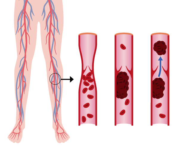Docotal's tweet image. What is Deep Vein Thrombosis? Diagnosis and Treatment dlvr.it/SXCw77