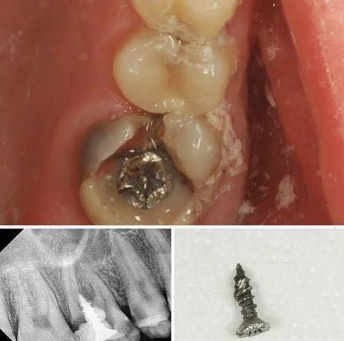 If I still haven’t deterred you from Dental tourism. See below, exhibit a: This is not a dental implant this is a wood screw purchased in a hardware store. I will now need to get a Philips screwdriver so I can surgically remove this from your head. 🤦🏽‍♂️