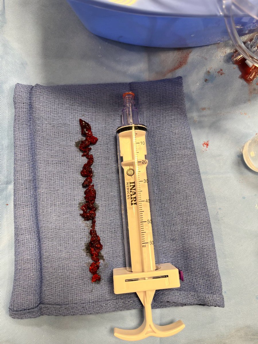 IndyIRmd's tweet photo. Brand new #Protrieve sheath with #ClotTriever worked perfectly for acute on chronic iliac vein thrombosis treated single session from jugular approach. Funnel made me feel comfortable no chance of embolization. Home same day. Happy patient! #irad #withoutascalpel #Indy #Inari https://t.co/yKBoLFuezA