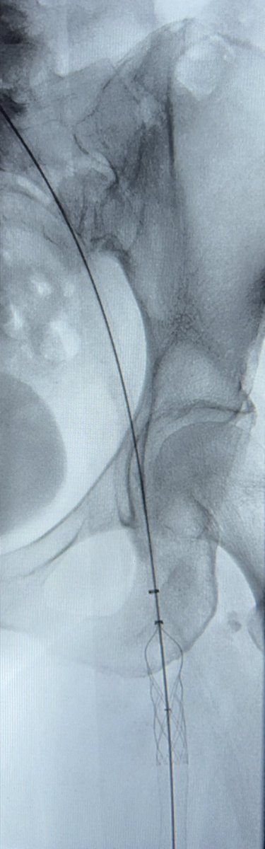 IndyIRmd's tweet photo. Brand new #Protrieve sheath with #ClotTriever worked perfectly for acute on chronic iliac vein thrombosis treated single session from jugular approach. Funnel made me feel comfortable no chance of embolization. Home same day. Happy patient! #irad #withoutascalpel #Indy #Inari https://t.co/yKBoLFuezA