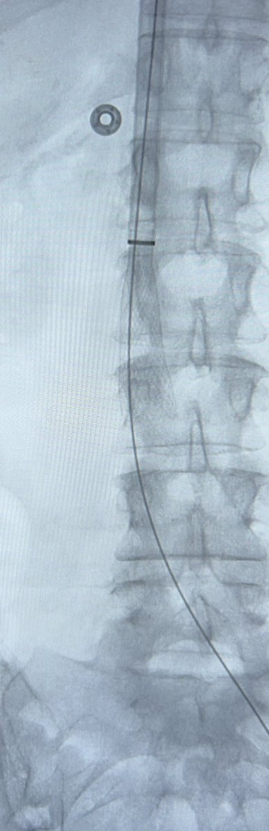 IndyIRmd's tweet photo. Brand new #Protrieve sheath with #ClotTriever worked perfectly for acute on chronic iliac vein thrombosis treated single session from jugular approach. Funnel made me feel comfortable no chance of embolization. Home same day. Happy patient! #irad #withoutascalpel #Indy #Inari https://t.co/yKBoLFuezA