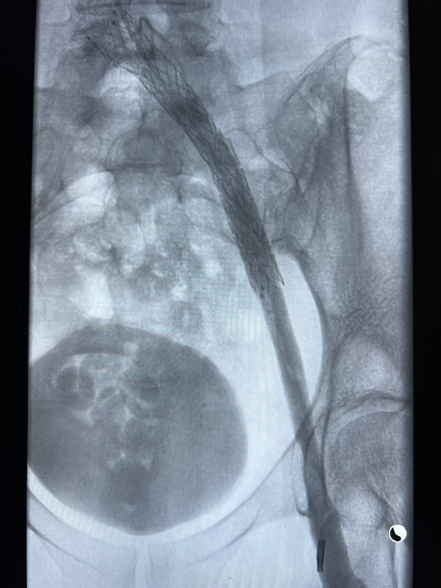IndyIRmd's tweet photo. Brand new #Protrieve sheath with #ClotTriever worked perfectly for acute on chronic iliac vein thrombosis treated single session from jugular approach. Funnel made me feel comfortable no chance of embolization. Home same day. Happy patient! #irad #withoutascalpel #Indy #Inari https://t.co/yKBoLFuezA