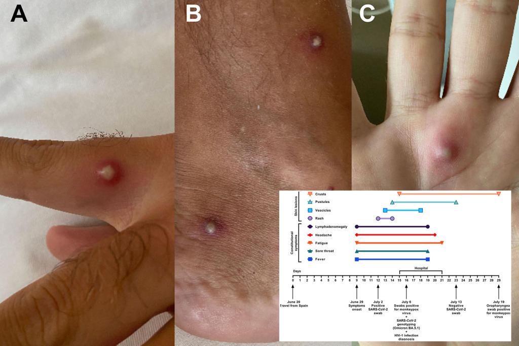 nypost's tweet photo. Italian man tests positive for COVID-19, monkeypox and HIV all on the same day https://t.co/M6fMkS7T5k https://t.co/Rb8EIcpMg7