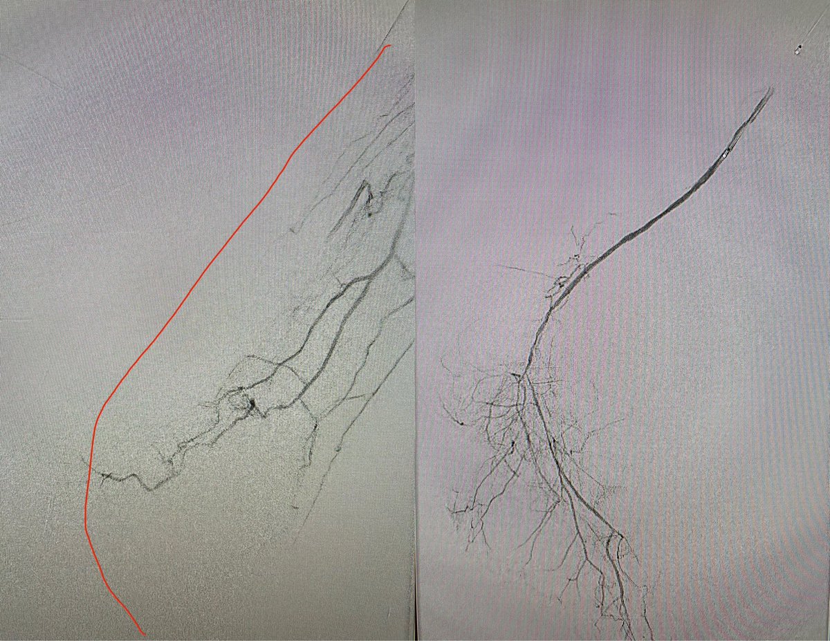 JohnAFryMD's tweet image. The modified Schmidt technique is a powerful tool to recanalize distally occluded tibial and inframalleolar vessels. Success rates are improved with use of EVUS for image guidance. #clifighters #stopthechop #savealeg