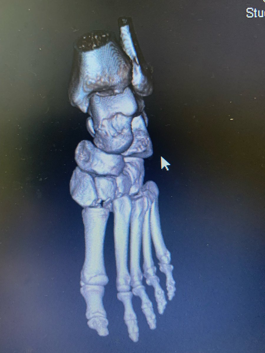 Chet’s injury is tough one. Saw a Lisfranc injury this summer and they can be pretty nasty. Here’s the CT