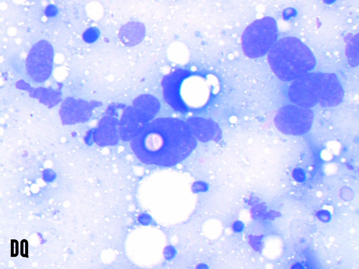 Miryousufkhan3's tweet photo. #cytonerd fact: melanin pigment appears blue on Diff quick and brown on pap-stained smears. FNA from a scalp nodule #cytopath #pathology https://t.co/oq1HK05Yw1