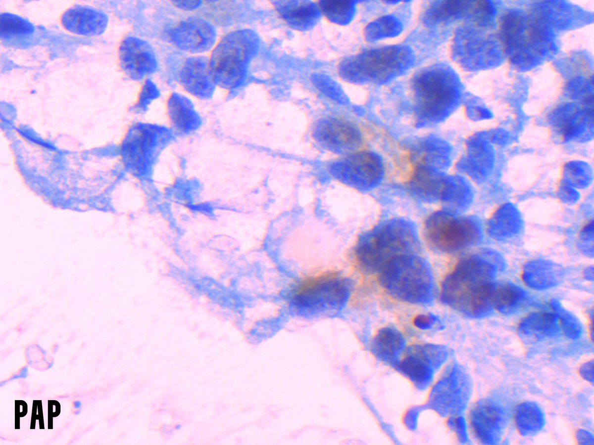 Miryousufkhan3's tweet photo. #cytonerd fact: melanin pigment appears blue on Diff quick and brown on pap-stained smears. FNA from a scalp nodule #cytopath #pathology https://t.co/oq1HK05Yw1