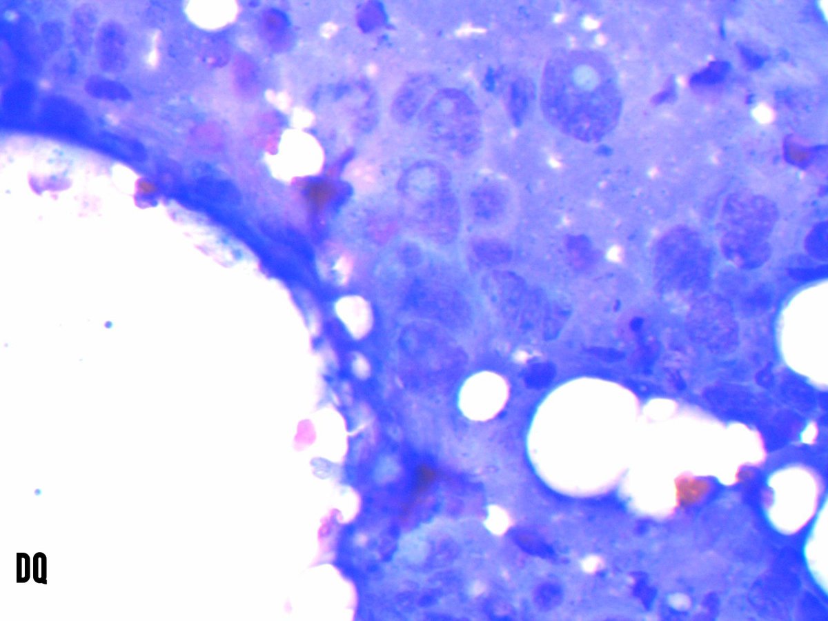 Miryousufkhan3's tweet photo. #cytonerd fact: melanin pigment appears blue on Diff quick and brown on pap-stained smears. FNA from a scalp nodule #cytopath #pathology https://t.co/oq1HK05Yw1