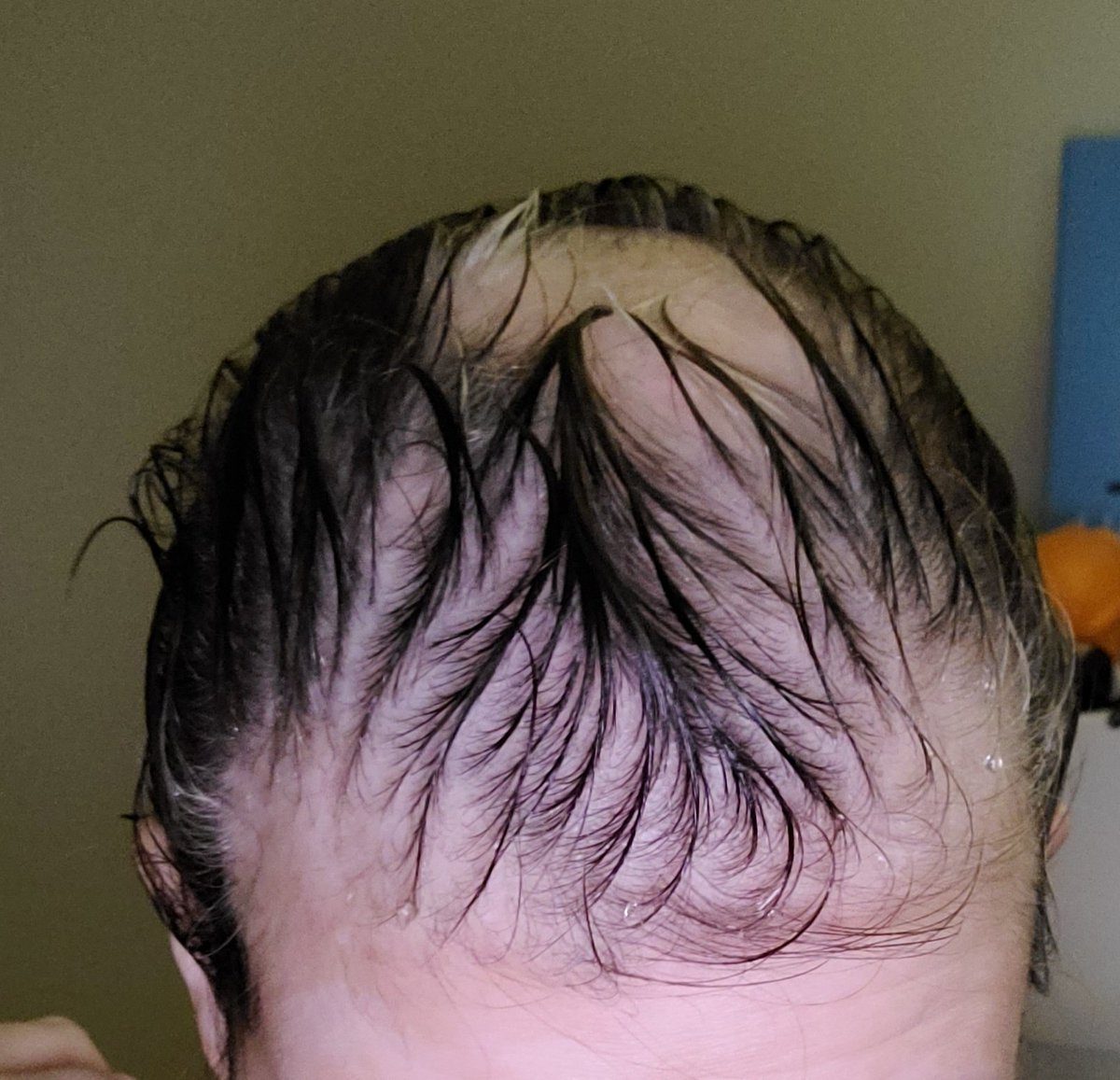 LibbyMbc's tweet image. 'Partial hairloss' thanks eribulin. It looks worse when wet, but bad all the time. 
#sideeffucks #sideeffects #iusedtolovemyhair #metastaticbreastcancer #terminal #cancer #metastatic