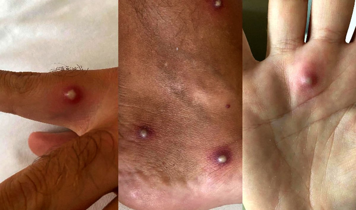 tvanouvelles's tweet photo. Déclaré positif à la COVID, à la variole simienne et au VIH en revenant de vacances https://t.co/WFIbH3sBgm https://t.co/1CcxAunPHw