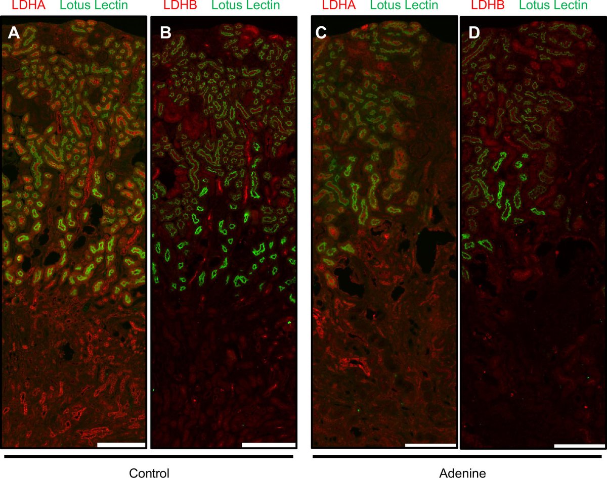 AJPRenal's tweet photo. Figure 6.
#Lactate dehydrogenase (LDH) isoform A (LDHA) and LDH isoform B (LDHB) expression in #ChronicKidneyDisease.
By: Gunars Osis, et al.
https://t.co/F168D3eiU5
#ImageOfTheWeek # AJPRenal #AKI #Metabolism @anupamuab @uabmedicine https://t.co/zSiRCd2Ud8