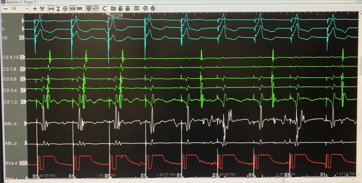 LeshemEran's tweet photo. Not many things in EP are more satisfying then treating pre-excited AF… 
62M with a LL AP. First burn, gone in less then 2 seconds… 
#EPeeps https://t.co/Jwe4uaqzhs