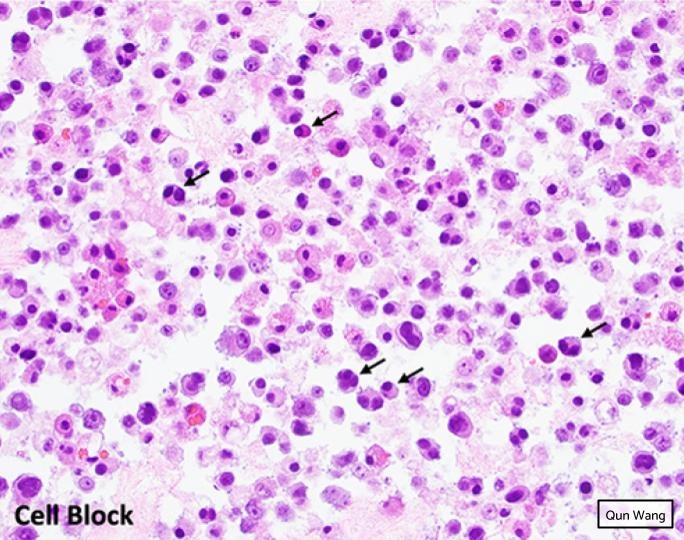GAPathologists's tweet photo. GAP Case of the Month #13:
51βοΈ w/ high-risk multiple myeloma, presents with massive left pleural effusion.
By: Dr. Qun Wang
π‘ Answer: https://t.co/QkKAJTRHm0
#GAPCoTM #cytopath #hemepath @EmoryPathology https://t.co/DZqfMwCUj3
