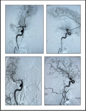 PenNeuro's tweet image. US HCPs: #RED62 provides a single-pass recanalization in the hands of Dr. Hansen from Medical City Forth Worth. #REDglideDifference Rx only. For risk info: bit.ly/37YcYIU Clinical results may vary.