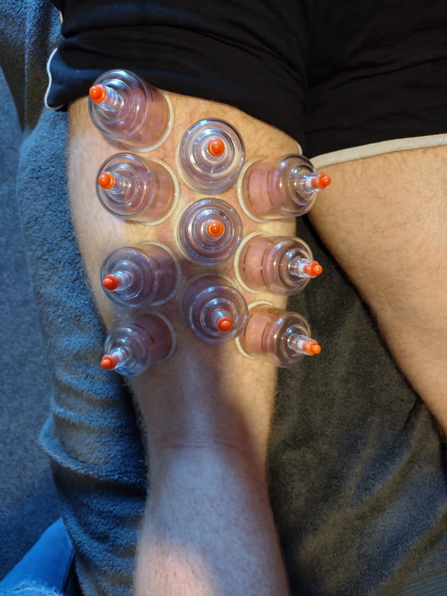 BWoodward1993's tweet photo. A little bit of cupping this evening. Long old process this injury malarkey๐ค Slowly but surely getting there tho ๐ค๐ป โฝ๏ธ #SoonBeBack https://t.co/E9MoTwX0UO