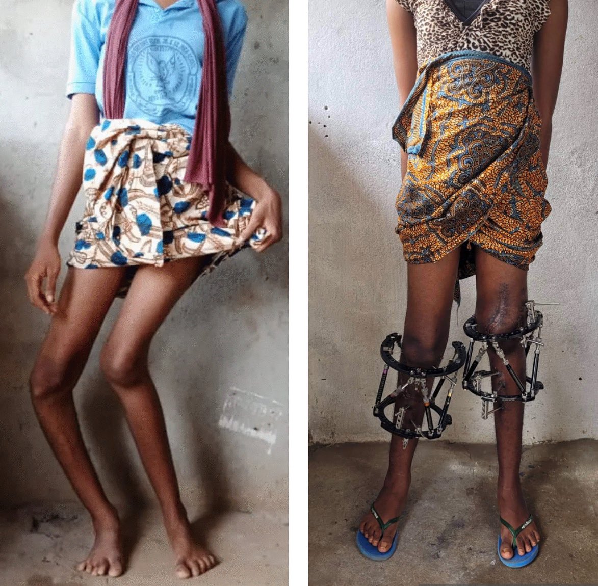 HealingLiberia's tweet photo. Before and after of our patient Makoto Sanoe. This young lady started her “straight legs” journey in January and she’s making great progress thanks to Dr. James Appel in Grand Cape Mount County. 

We are so happy to continue to make an impact in the lives of young Liberians 🙏🏾 https://t.co/3KRLH95C5n