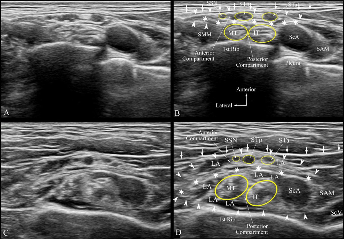 RAPMOnline's tweet photo. High-definition ultrasound imaging of the paraneural sheath and fascial compartments surrounding the brachial plexus at the supraclavicular fossa

https://t.co/JHg7EyDj1E

@Sivakumar_SRK @ESchwenkMD @dr_rajgupta 

#RegionalAnesthesia #PainMedicine #Ultrasound #Nerveblock https://t.co/qQCw70mAgA