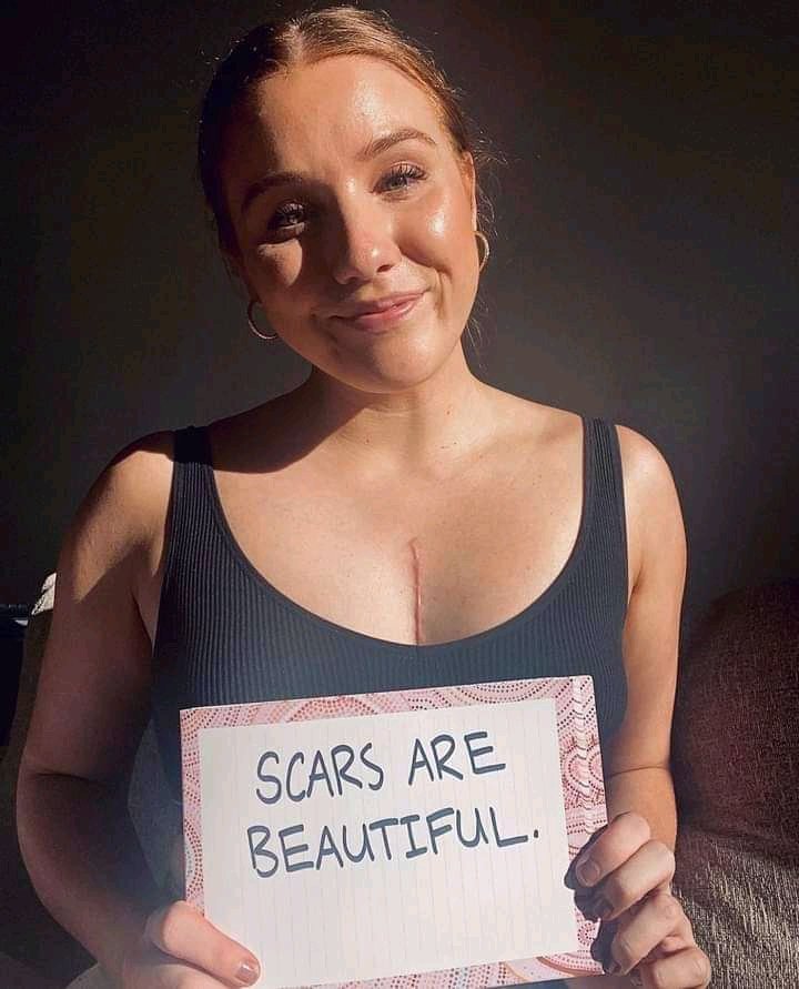 scarpowerco's tweet photo. This is Bee from Sydney. she was diagnosed with obstructed hypertrophic cardiomyopathy when she was 14 through genetic testing. Her aim is to raise awareness around heart disease in young people and normalise scars. @beesbighear
Visit https://t.co/25LFAmTy5Q
#scarpower https://t.co/1RA322FEij