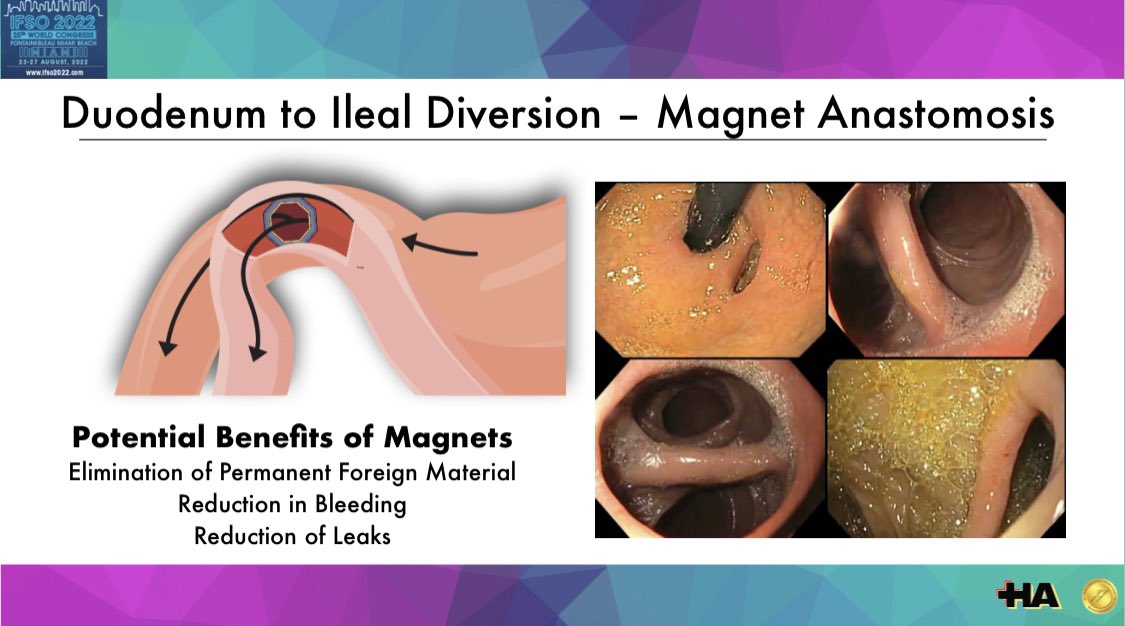 Rudolf Buxhoeveden (@rudolfbux) on Twitter photo Presentando resultados a 2 años de procedimiento inédito metabólico con anastomosis magnética en pacientes con diabetes tipo II en #ifso2022. Presenting 2y results in new Metabolic magnetic anastomosis procedure for T2DM at #IFSOmiami2022 <a href="/WindowsGi/">GI Windows Surgical</a> <a href="/RomanTurro/">Dr Roman Turro</a> <a href="/HAlemanBsAs/">Hospital Alemán</a> Presentando resultados a 2 años de procedimiento inédito metabólico con anastomosis magnética en pacientes con diabetes tipo II en #ifso2022. Presenting 2y results in new Metabolic magnetic anastomosis procedure for T2DM at #IFSOmiami2022 <a href="/WindowsGi/">GI Windows Surgical</a> <a href="/RomanTurro/">Dr Roman Turro</a> <a href="/HAlemanBsAs/">Hospital Alemán</a>