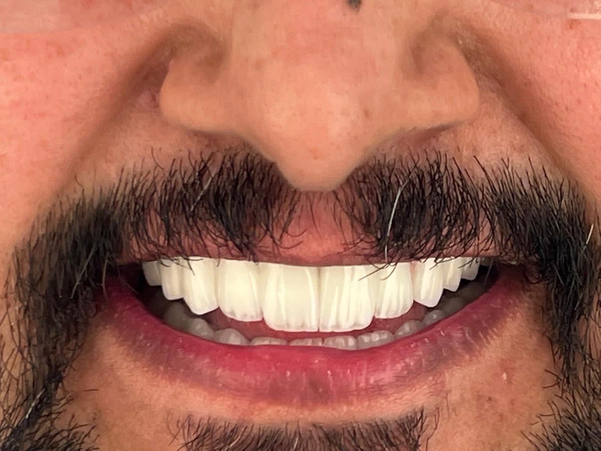 DrAlgufari's tweet photo. يسعدنا دائم التعاون مع زملائنا الاطباء في جميع الشرق الاوسط وتقديم الدعم لهذه التقنيات الحديثة للزراعة الرقمية باستخدام تقنيات الطباعة ثلاثية الابعاد . د.حسام عاشور -الكويت/مصر و معالجة مميزة
#زراعة_اسنان رقمية في الفك العلوي #boneeasy .
وزراعة اسنان تقليدية للفك السفلي . https://t.co/5lMA5FprD6
