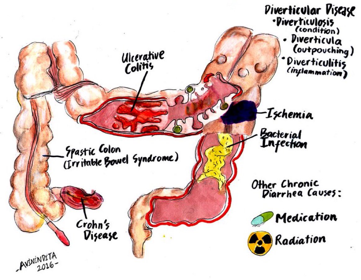 Paul_Wischmeyer's tweet photo. Common causes of chronic diarrhea ๐ฉ
#MedEd #MedTwitter #FOAMed
Courtesy of @chungk1031 & @armando71021105 https://t.co/mTlYPq7uhK