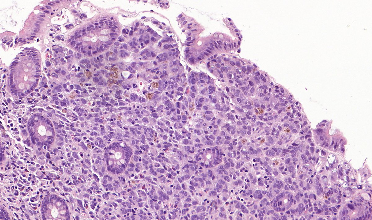 TristanRutland7's tweet photo. ⚕️Caecal polyp, older patient
✏️Request form:
➡️Dysuria
➡️Previous appendicectomy and hysterectomy.
#GITpath #pathresidents #Pathtwitter https://t.co/rYyofbmhKi