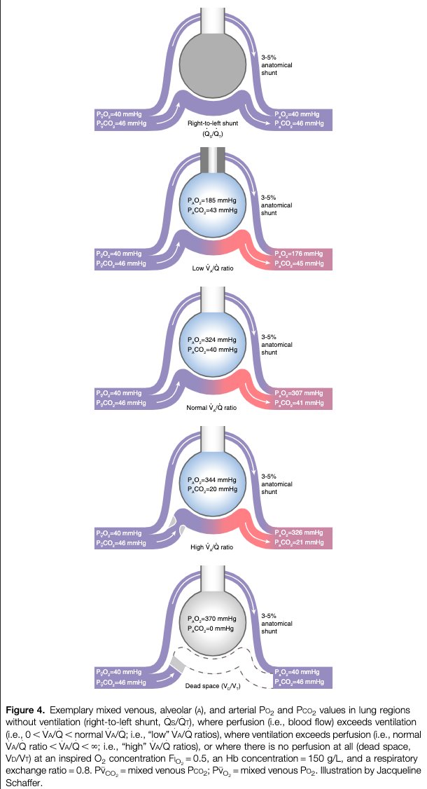 msiuba's tweet photo. This @ATSBlueEditor review on gas exchange in #ARDS is a great reminder of how complex the disease process is and how the effects of our interventions can be unpredictable.

A core curricular read for intensivists and trainees.

https://t.co/e7ycGLk6u6 https://t.co/U5gB3t0hJu