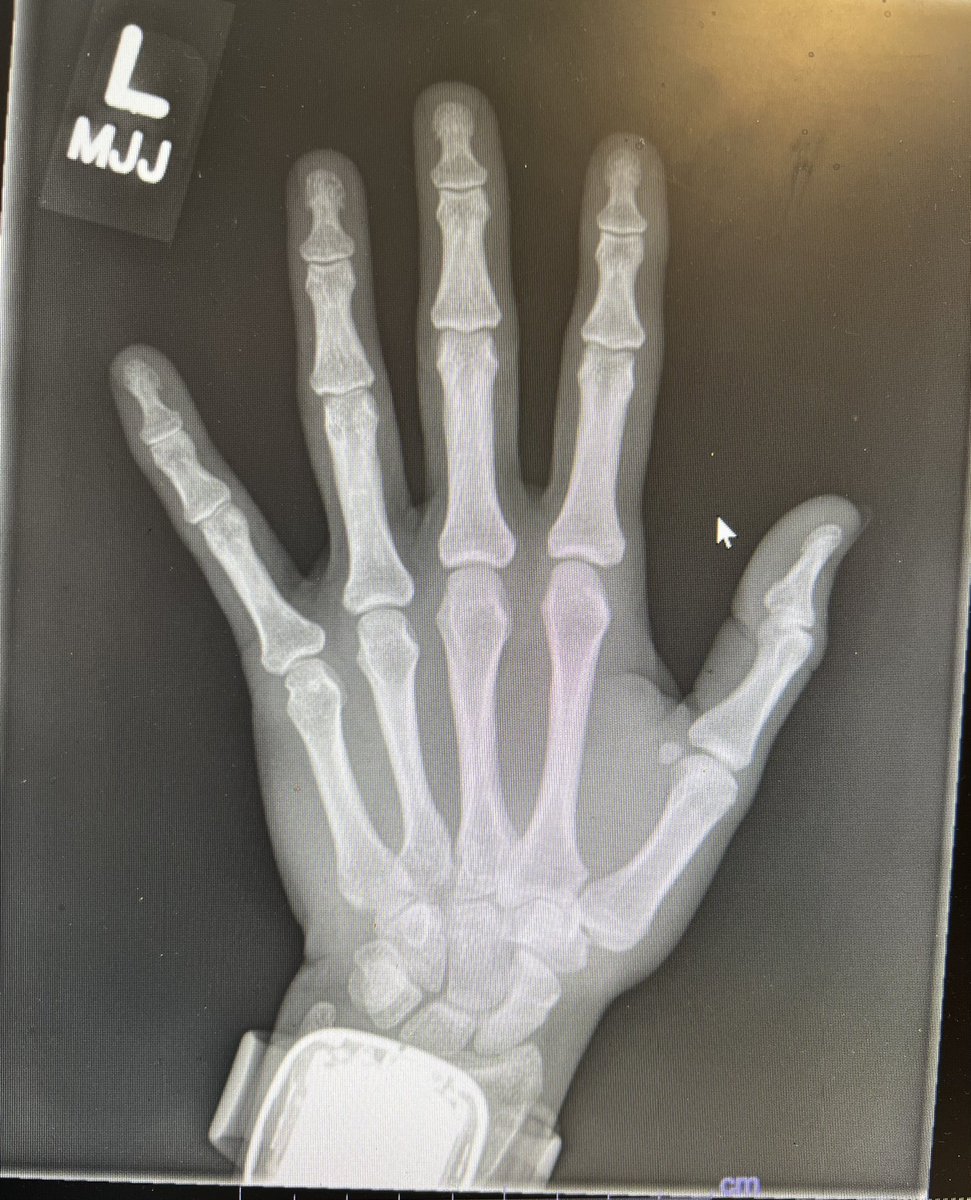 rkh_md's tweet photo. It takes 5 seconds…#orthotwitter #radtwitter https://t.co/xVWSU2Ddkv