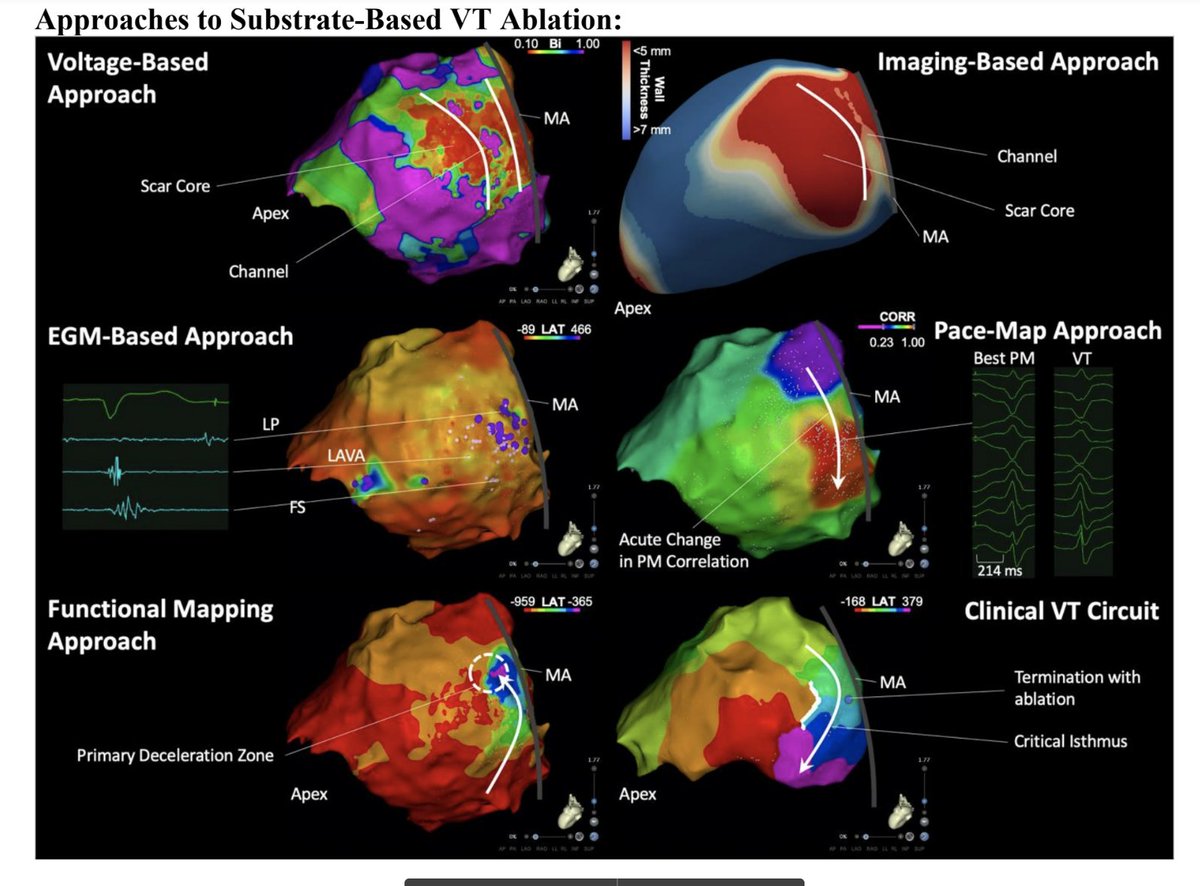 A/Prof GeoffLee (@drgeofflee) on Twitter photo Take a 👀 at our latest review paper by our super fellow <a href="/JoshuaHawson/">Joshua Hawson</a> on Substrate-based Approaches in VT Ablation in <a href="/IPEJ_journal/">Indian Pacing and Electrophysiology Journal</a> (doi.org/10.1016/j.ipej…) <a href="/Dr_RobAnderson/">Robert Anderson</a> <a href="/AhmedAlkaisey/">Ahmed Al-Kaisey</a> <a href="/joem_c/">Joe Morton</a> <a href="/Troy_The/">Troy M Watts</a> @SaurabhkumarEp <a href="/peterkistler3/">peterkistler MBBS PhD FHRS</a> <a href="/JonKalmanEP/">Jonathan Kalman</a> Take a 👀 at our latest review paper by our super fellow <a href="/JoshuaHawson/">Joshua Hawson</a> on Substrate-based Approaches in VT Ablation in <a href="/IPEJ_journal/">Indian Pacing and Electrophysiology Journal</a> (doi.org/10.1016/j.ipej…) <a href="/Dr_RobAnderson/">Robert Anderson</a> <a href="/AhmedAlkaisey/">Ahmed Al-Kaisey</a> <a href="/joem_c/">Joe Morton</a> <a href="/Troy_The/">Troy M Watts</a> @SaurabhkumarEp <a href="/peterkistler3/">peterkistler MBBS PhD FHRS</a> <a href="/JonKalmanEP/">Jonathan Kalman</a>