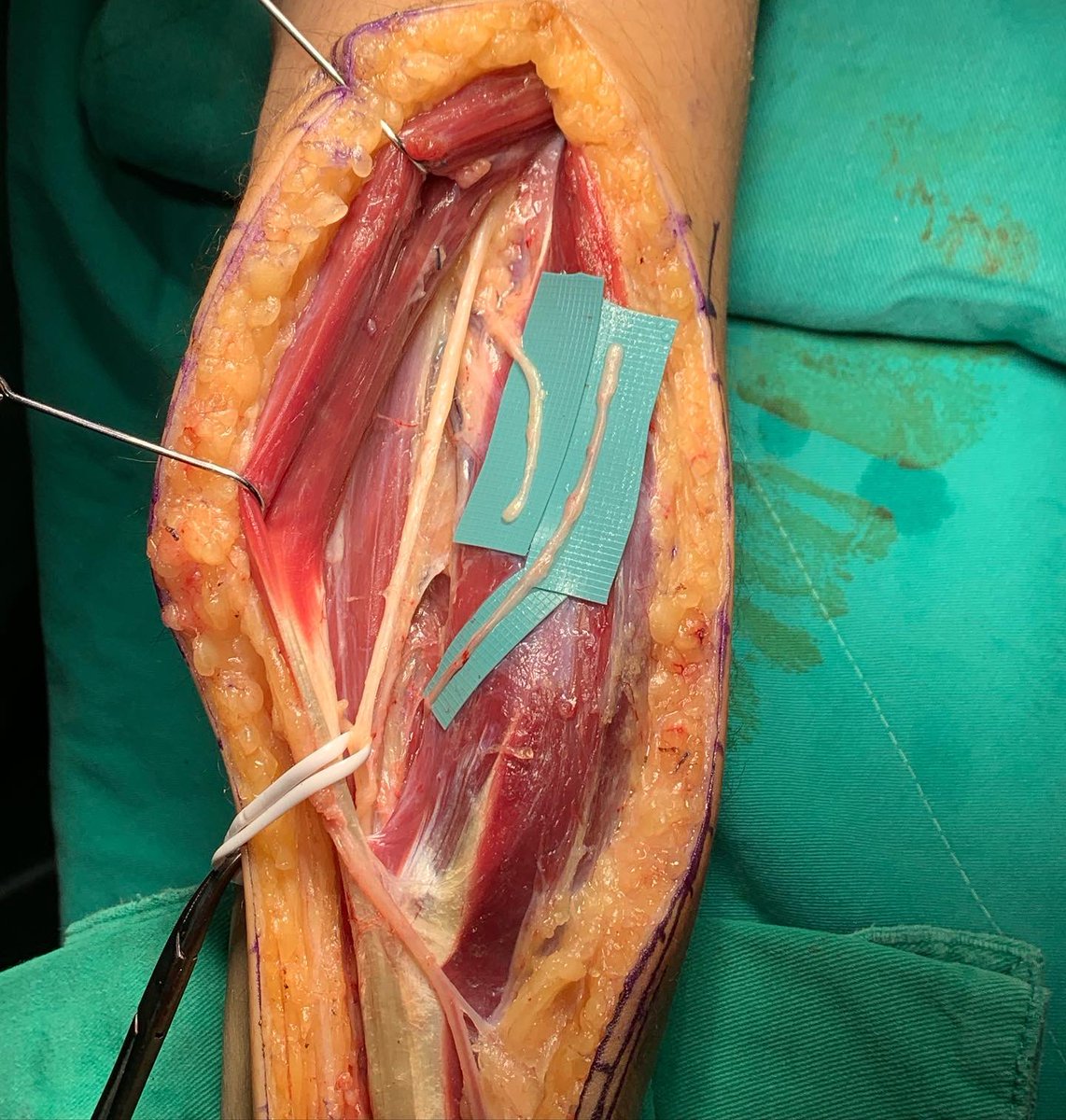 cylu122's tweet photo. Close target nerve transfers for incomplete brachial plexus injuries

https://t.co/pLmbVqxVTh

#nervenerds #brachialplexus #brachialplexusinjuries #nervetransfers #microsurgery https://t.co/4zZ0IuVjec