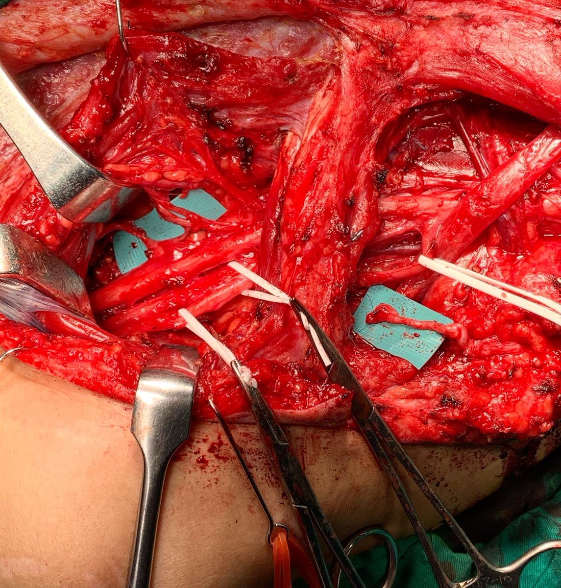 cylu122's tweet photo. Close target nerve transfers for incomplete brachial plexus injuries

https://t.co/pLmbVqxVTh

#nervenerds #brachialplexus #brachialplexusinjuries #nervetransfers #microsurgery https://t.co/4zZ0IuVjec