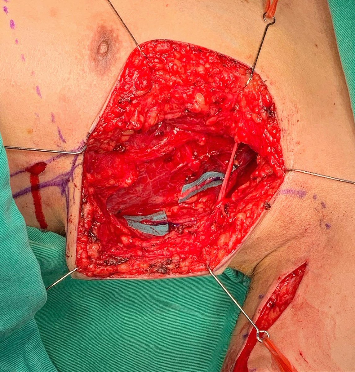 cylu122's tweet photo. Close target nerve transfers for incomplete brachial plexus injuries

https://t.co/pLmbVqxVTh

#nervenerds #brachialplexus #brachialplexusinjuries #nervetransfers #microsurgery https://t.co/4zZ0IuVjec