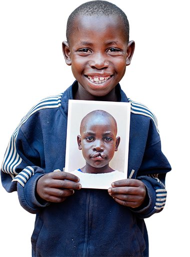 live_likeSuzzy's tweet photo. Gentle reminder that SMILE TRAIN covers the cost of treatment and nutrition for these kids. There are partners all over Africa, please send a dm and share if you come across such case. https://t.co/hvpKvMeuSk