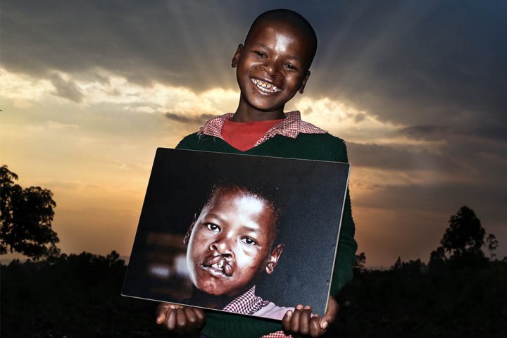 live_likeSuzzy's tweet photo. Gentle reminder that SMILE TRAIN covers the cost of treatment and nutrition for these kids. There are partners all over Africa, please send a dm and share if you come across such case. https://t.co/hvpKvMeuSk
